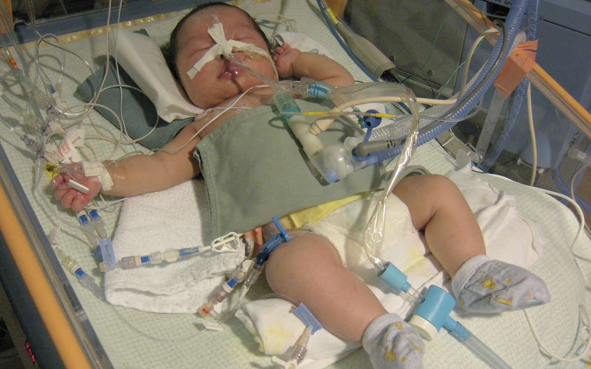 An infant boy lies in an intensive care nursery with multiple tubes attached to his nose and body.