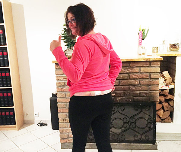 Bone marrow donor standing, giving thumbs up with small bandages on the back of her pelvis