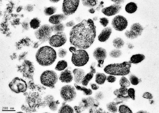 Electron micrograph of microparticles found in the supernatant of a freshly prepared RBC unit. Microparticles ranged from 50-600 nm in diameter, with many around 200 nm. Photo credit: BSRI, Adapted from Danesh et al., Blood 123:687-96 (2014). Electron micrograph of microparticles found in the supernatant of a freshly prepared RBC unit. Microparticles ranged from 50-600 nm in diameter, with many around 200 nm. Photo credit: BSRI, Adapted from Danesh et al., Blood 123:687-96 (2014).