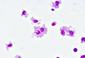 Hematological staining of cells in a monocyte monolayer assay performed using sub-optimal conditions. Hematological staining of cells in a monocyte monolayer assay performed using sub-optimal conditions.