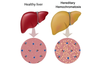 Hereditary Hemochromatosis, shutterstock Hereditary Hemochromatosis, shutterstock