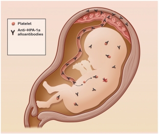 Diagram adapted from A Platelet Coverup by Donald M. Arnold, Blood 2013 122:307-309, reproduced with permission.