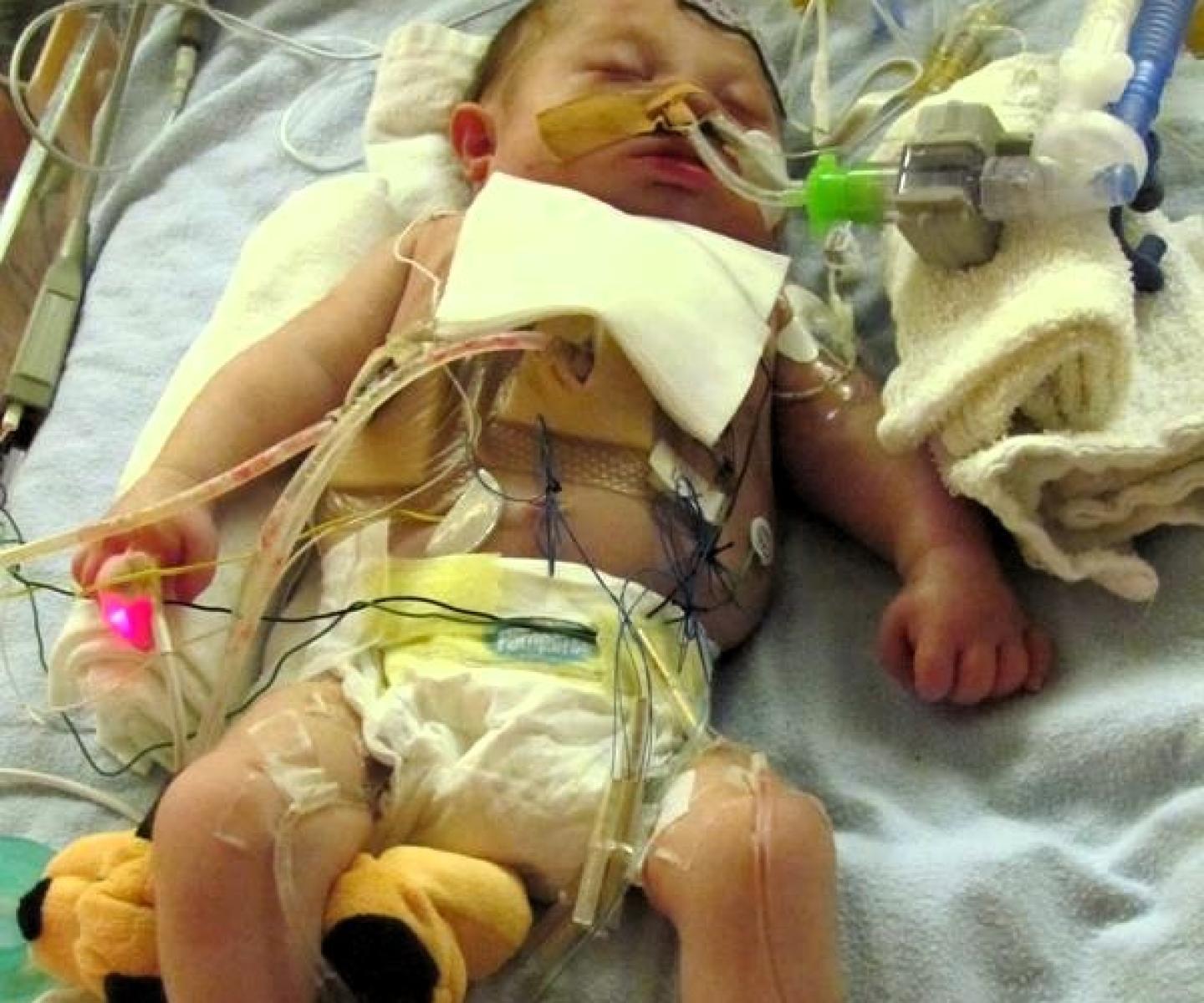 Infant in diaper on hospital bed connected to tubes